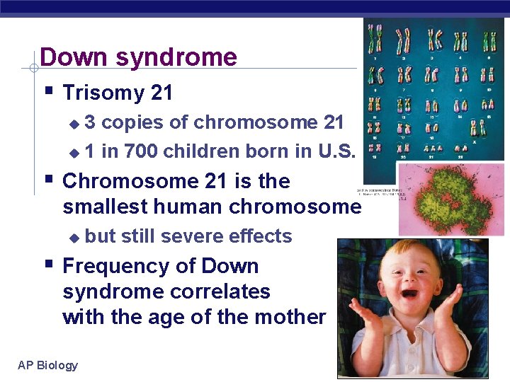 Down syndrome Trisomy 21 3 copies of chromosome 21 1 in 700 children born