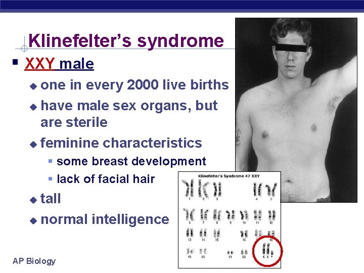 Klinefelter’s syndrome XXY male one in every 2000 live births have male sex organs,