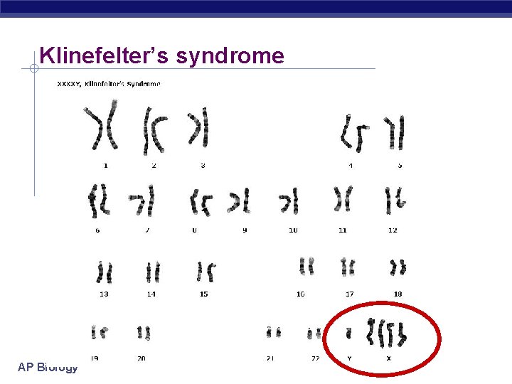 Klinefelter’s syndrome AP Biology 