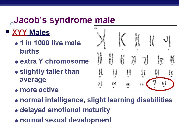Jacob’s syndrome male XYY Males 1 in 1000 live male births extra Y chromosome