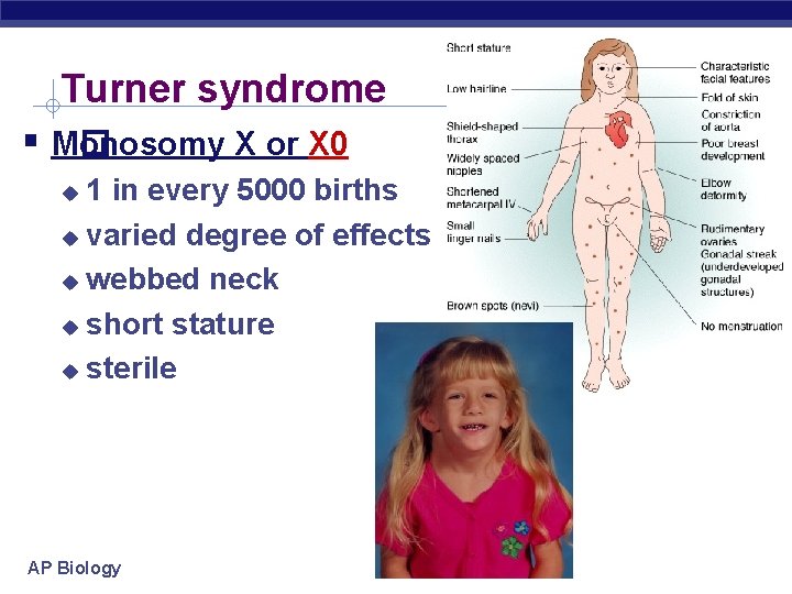 Turner syndrome M� onosomy X or X 0 1 in every 5000 births varied