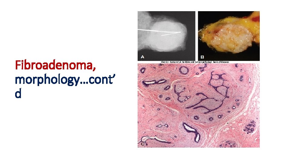 Fibroadenoma, morphology…cont’ d Elsevier. Kumar et al. Robbins and Cotran pathologic basis of diseases