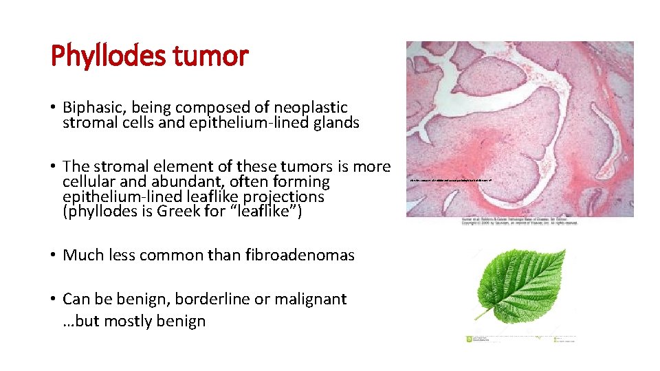 Phyllodes tumor • Biphasic, being composed of neoplastic stromal cells and epithelium-lined glands •
