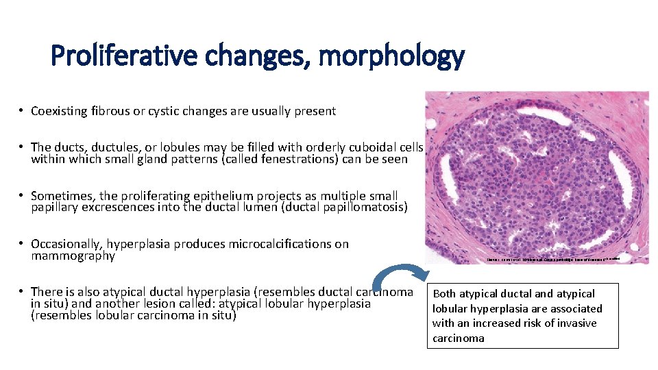 Proliferative changes, morphology • Coexisting fibrous or cystic changes are usually present • The
