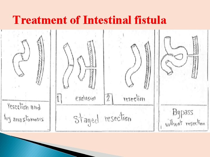 Treatment of Intestinal fistula 