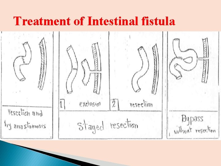 Treatment of Intestinal fistula Treatment of Intestinal fistula