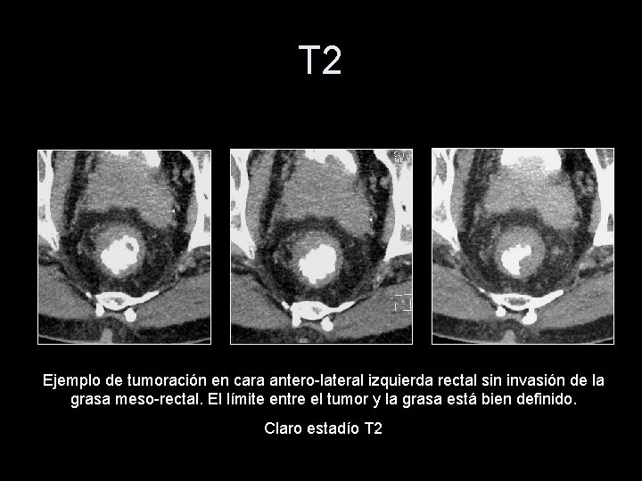T 2 Ejemplo de tumoración en cara antero-lateral izquierda rectal sin invasión de la