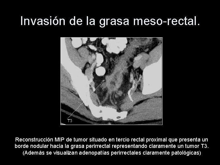Invasión de la grasa meso-rectal. Reconstrucción MIP de tumor situado en tercio rectal proximal