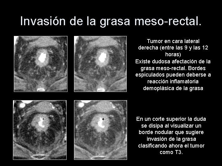 Invasión de la grasa meso-rectal. Tumor en cara lateral derecha (entre las 9 y