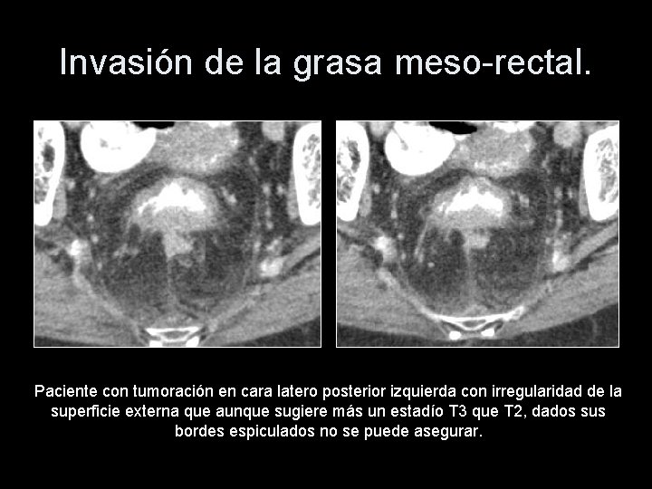 Invasión de la grasa meso-rectal. Paciente con tumoración en cara latero posterior izquierda con