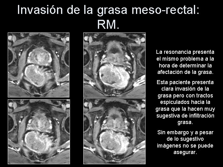 Invasión de la grasa meso-rectal: RM. La resonancia presenta el mismo problema a la