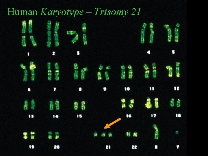 Human Karyotype – Trisomy 21 Lyse Cell and its Nucleus 