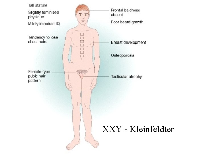 XXY - Kleinfeldter 