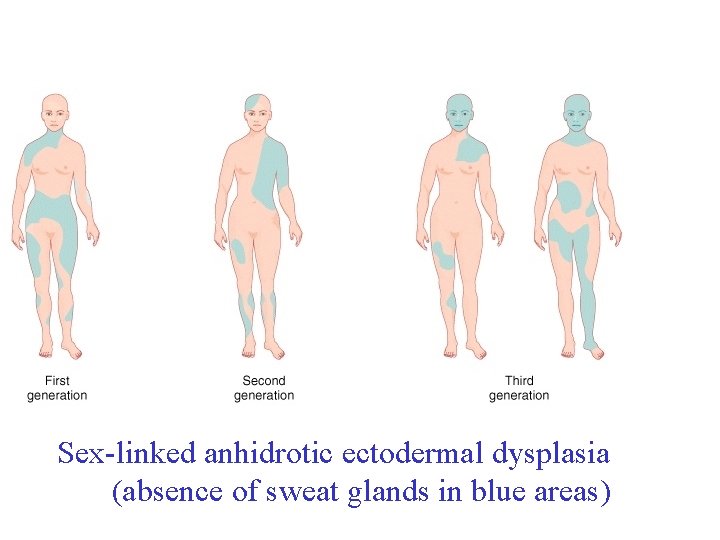Sex-linked anhidrotic ectodermal dysplasia (absence of sweat glands in blue areas) 