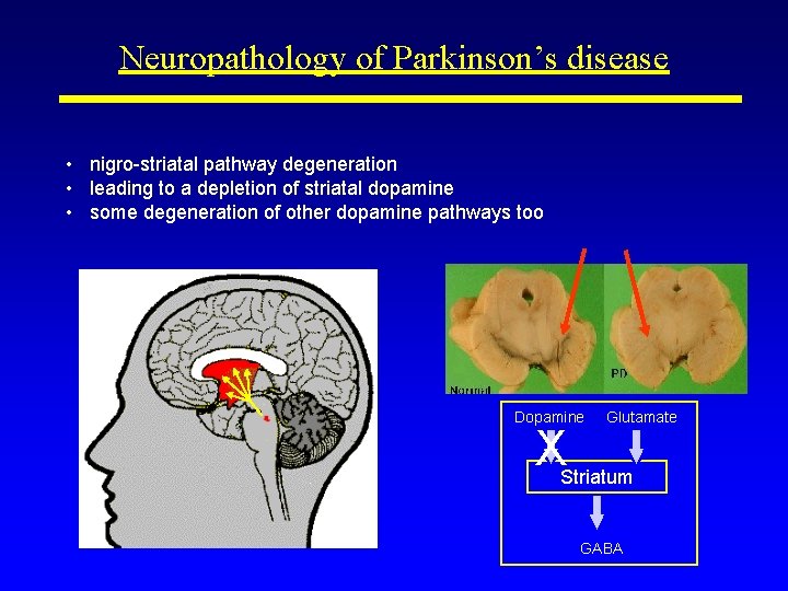 Neuropathology of Parkinson’s disease • nigro-striatal pathway degeneration • leading to a depletion of