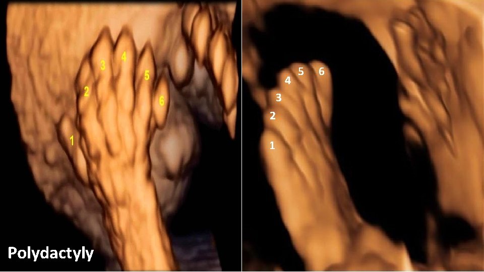 4 3 2 1 Polydactyly 5 6 
