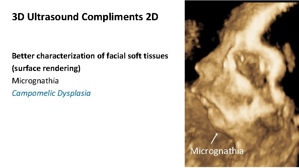 3 D Ultrasound Compliments 2 D Better characterization of facial soft tissues (surface rendering)