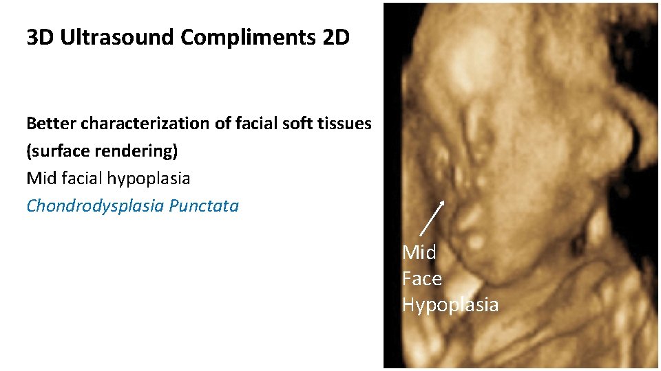 3 D Ultrasound Compliments 2 D Better characterization of facial soft tissues (surface rendering)