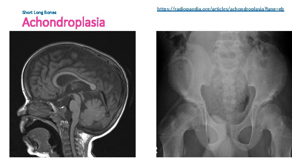 Short Long Bones Achondroplasia https: //radiopaedia. org/articles/achondroplasia? lang=gb 