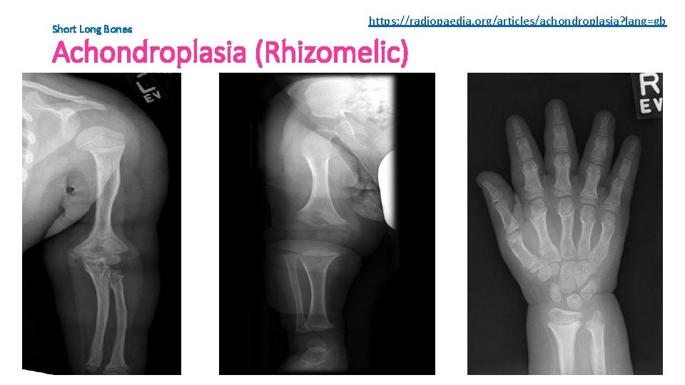 Short Long Bones https: //radiopaedia. org/articles/achondroplasia? lang=gb Achondroplasia (Rhizomelic) 
