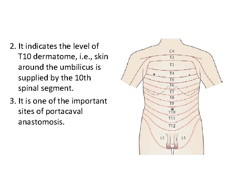 2. It indicates the level of T 10 dermatome, i. e. , skin around 2. It indicates the level of T 10 dermatome, i. e. , skin around