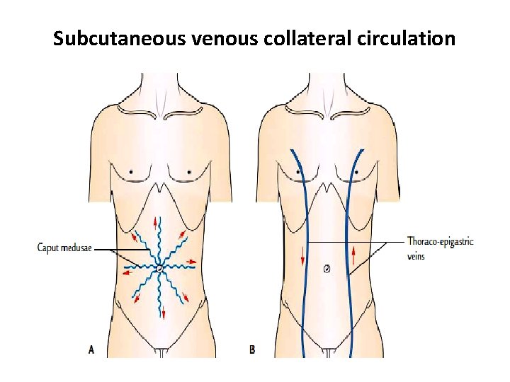 Subcutaneous venous collateral circulation  Subcutaneous venous collateral circulation