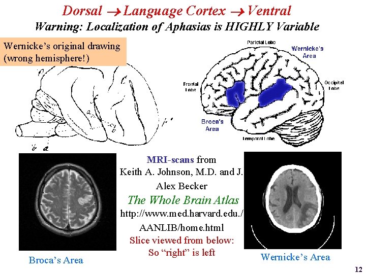 Dorsal Language Cortex Ventral Warning: Localization of Aphasias is HIGHLY Variable Wernicke’s original drawing