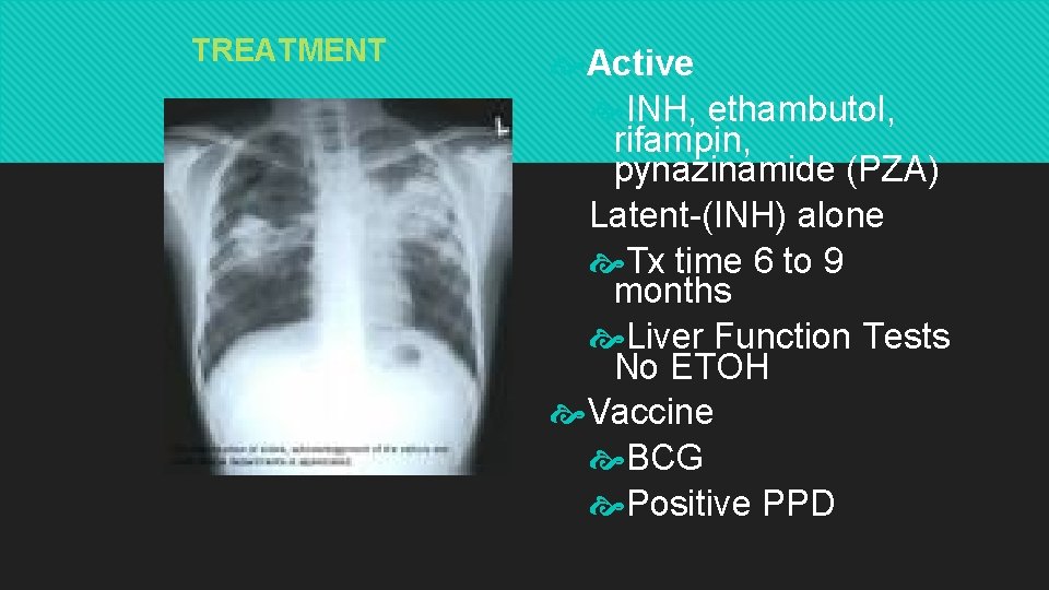 TREATMENT Active INH, ethambutol, rifampin, pynazinamide (PZA) Latent-(INH) alone Tx time 6 to 9