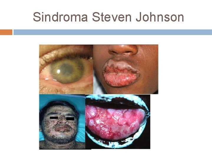 Sindroma Steven Johnson 