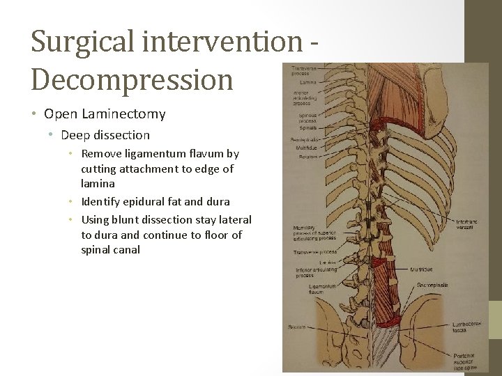 Surgical intervention Decompression • Open Laminectomy • Deep dissection • Remove ligamentum flavum by