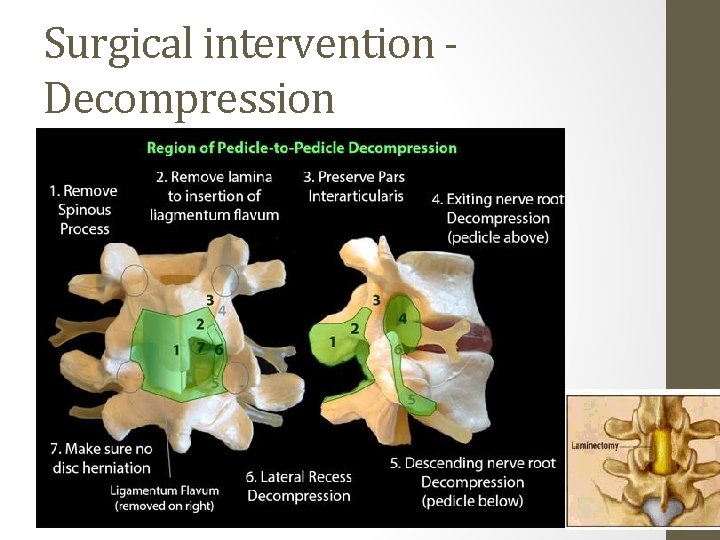 Surgical intervention Decompression 