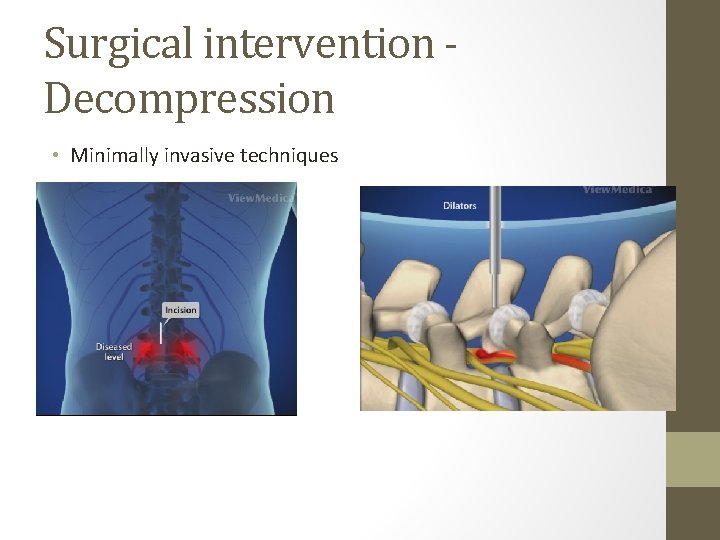 Surgical intervention Decompression • Minimally invasive techniques 