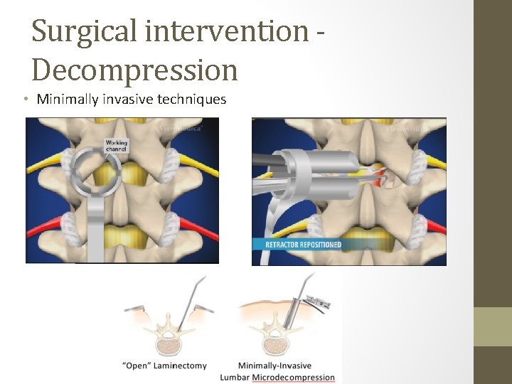 Surgical intervention Decompression • Minimally invasive techniques 