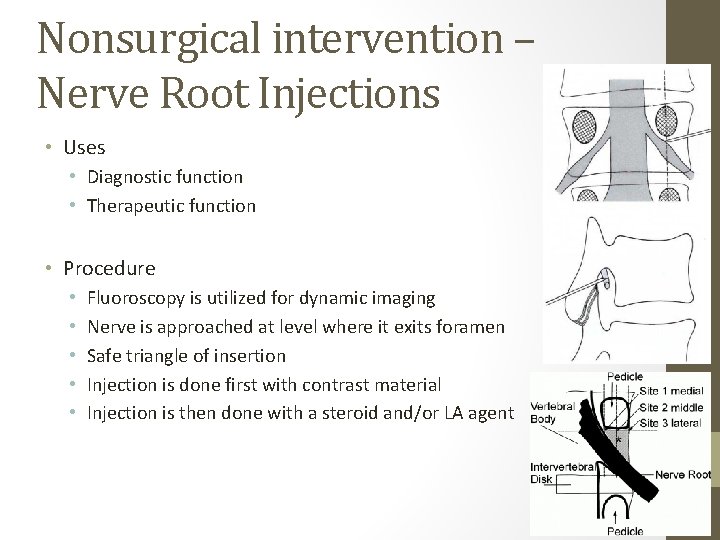 Nonsurgical intervention – Nerve Root Injections • Uses • Diagnostic function • Therapeutic function
