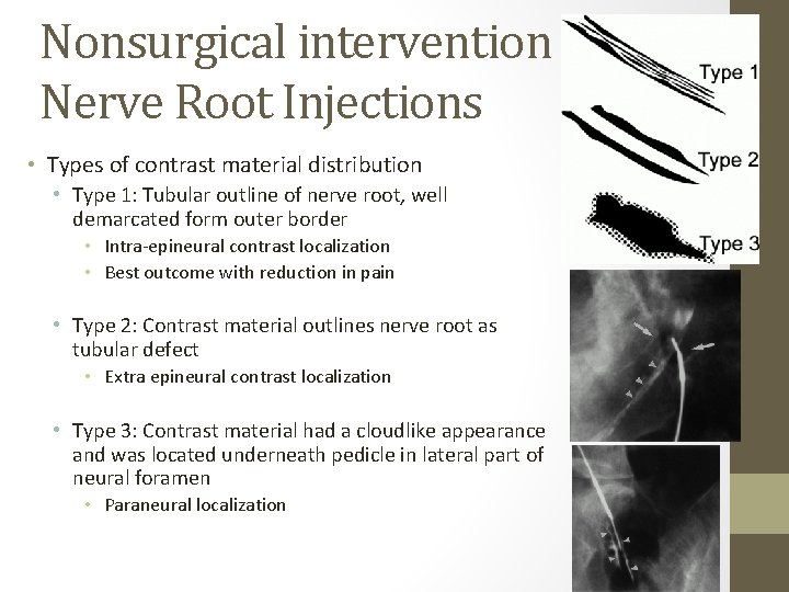 Nonsurgical intervention – Nerve Root Injections • Types of contrast material distribution • Type
