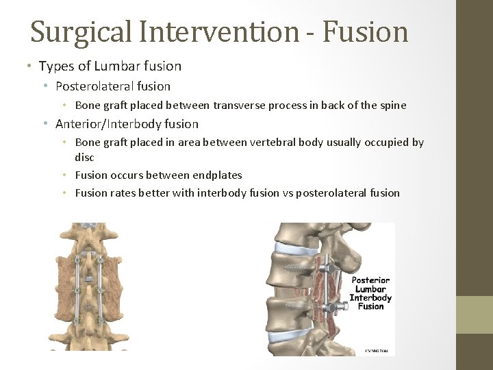 Surgical Intervention - Fusion • Types of Lumbar fusion • Posterolateral fusion • Bone