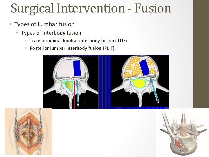 Surgical Intervention - Fusion • Types of Lumbar fusion • Types of Interbody fusion