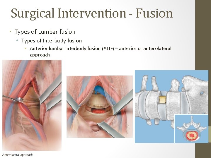 Surgical Intervention - Fusion • Types of Lumbar fusion • Types of Interbody fusion