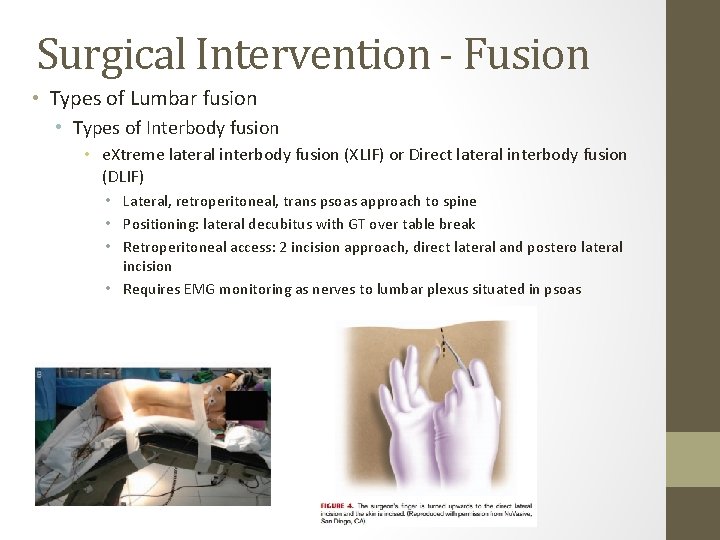 Surgical Intervention - Fusion • Types of Lumbar fusion • Types of Interbody fusion