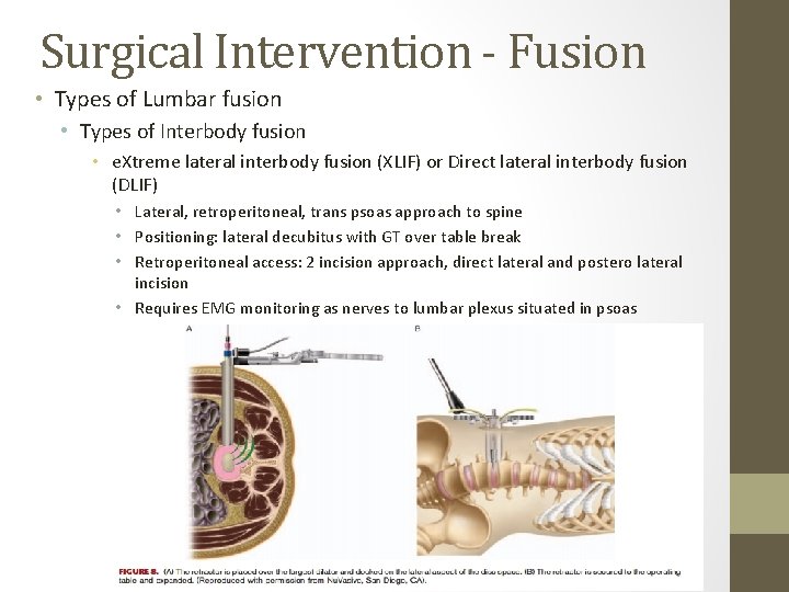 Surgical Intervention - Fusion • Types of Lumbar fusion • Types of Interbody fusion