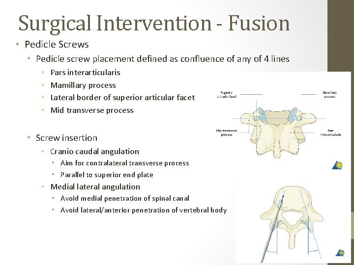 Surgical Intervention - Fusion • Pedicle Screws • Pedicle screw placement defined as confluence