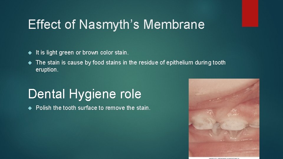 Effect of Nasmyth’s Membrane It is light green or brown color stain. The stain