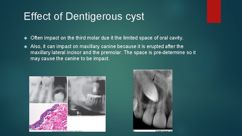 Effect of Dentigerous cyst Often impact on the third molar due it the limited