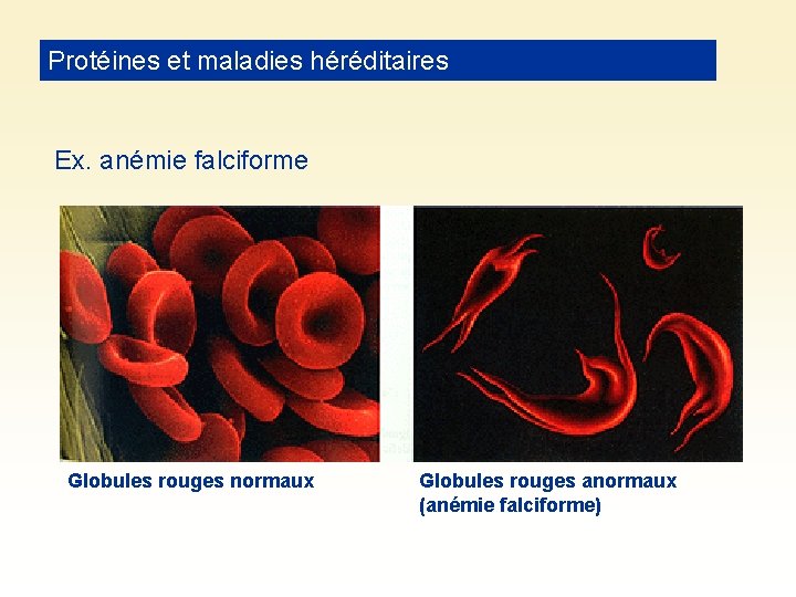 Protéines et maladies héréditaires Ex. anémie falciforme Globules rouges normaux Globules rouges anormaux (anémie