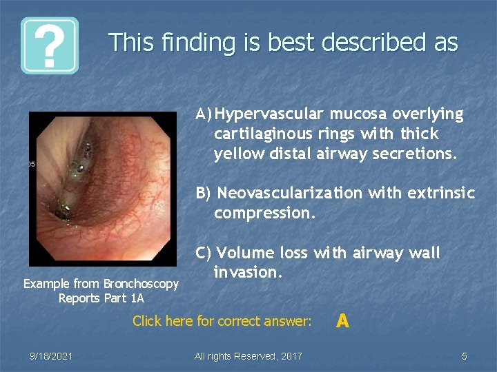 This finding is best described as A) Hypervascular mucosa overlying cartilaginous rings with thick
