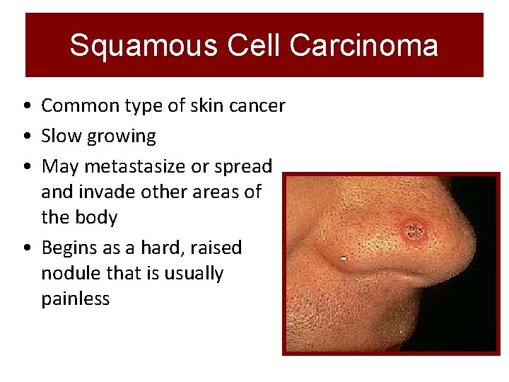 Squamous Cell Carcinoma • Common type of skin cancer • Slow growing • May