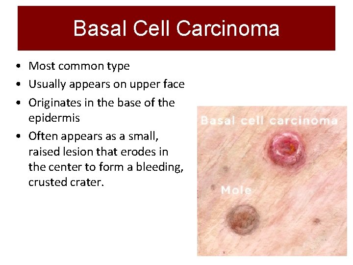 Basal Cell Carcinoma • Most common type • Usually appears on upper face •