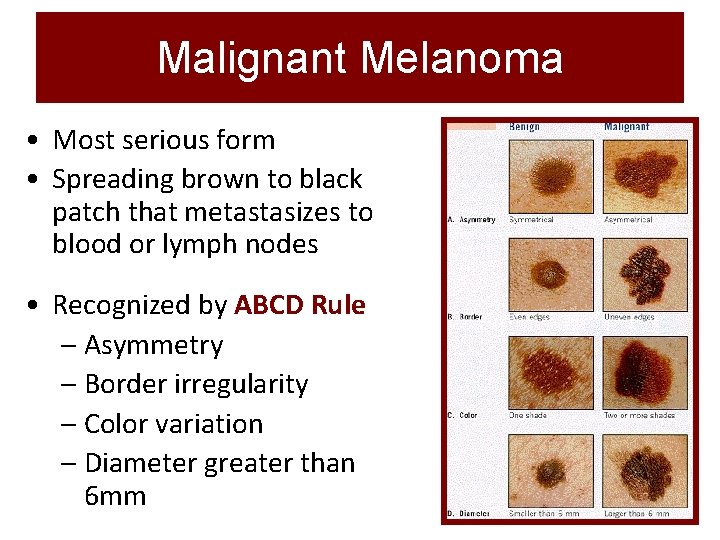 Malignant Melanoma • Most serious form • Spreading brown to black patch that metastasizes