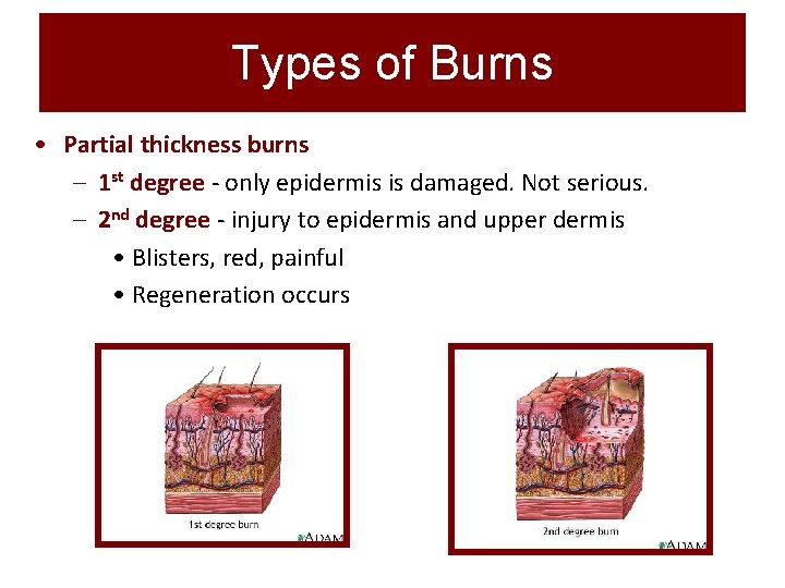 Types of Burns • Partial thickness burns – 1 st degree - only epidermis