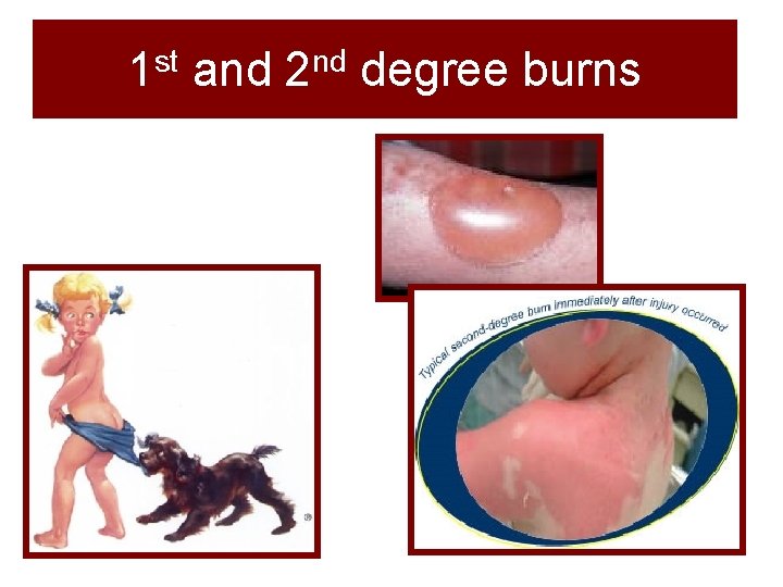 1 st and 2 nd degree burns 